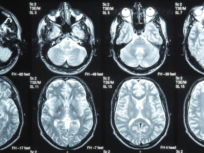 The Brain’s Response to Childhood Trauma and How to Heal Through Positive Relationships